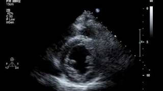 Hypokinesis Mitral Regurgitation Aortic Insufficiency [upl. by Onibag]