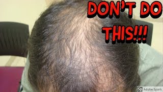 NO HAIR LOSS MEDS AFTER HAIR TRANSPLANT YOURE CRAZY [upl. by Ishii633]