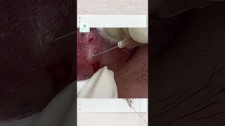 Big Cystic Acne Blackheads Extraction Blackheads amp Milia Whiteheads Removal Pimple Popping Shorts [upl. by Doloritas]