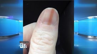 Melanoma on Your Nail [upl. by Oirazan223]