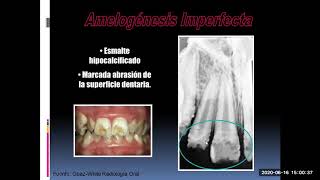 Clase de Anomalias dentarias [upl. by Hauser346]