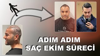 Adım Adım Saç Ekimi I FATMA DURSUN [upl. by Schwenk751]