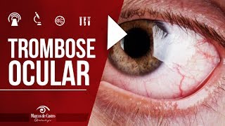 O que é trombose ocular  Dr Marcos de Castro Oftalmologia [upl. by Nnylhtak]