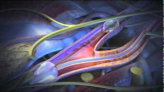 Angioplasty Stenting Atherectomy and Thrombolysis [upl. by Ardeed]