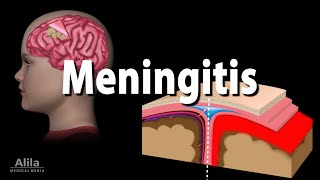 Meningitis Pathology Causes Symptoms Diagnosis and Treatment Animation [upl. by Annaihr822]