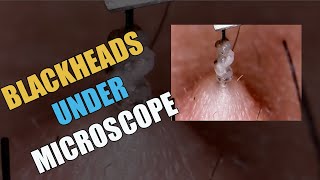 WEIRD BLACKHEADS UNDER MICROSCOPE [upl. by Yrolg]