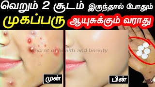 இனி ஆயிள் முழுவதும் முகப்பரு வரவே வராது  muga parukkal poga tips in tamil  beauty tips in tamil [upl. by Brindle411]