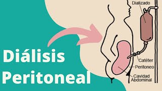 ¿Qué es la diálisis peritoneal [upl. by Gnol]