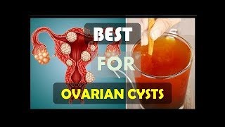 How To Get Rid Of Ovarian Cysts Naturally And Fast Home Remedies For Natural Treatment [upl. by Dickerson]