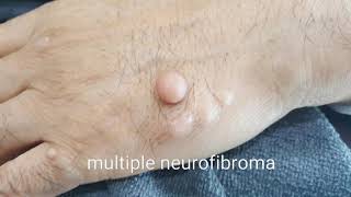 신경섬유종 Neurofibroma [upl. by Spurgeon]