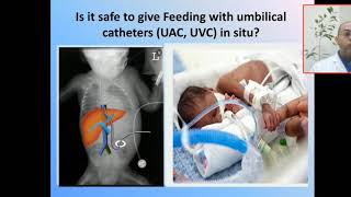 Is it safe practice to give feeding with umblical catheters  UAC UVC in situ Minimal enteral fee [upl. by Carnahan]