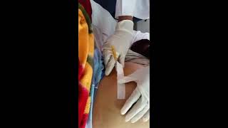 Tapping procedure for Ascites quot Paracentesis quot 1 [upl. by Nibroc997]