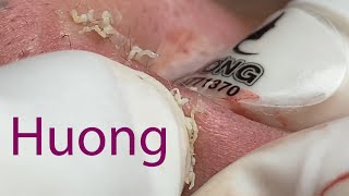 Acne Treatment Huong Da Nang570  2023 [upl. by Huey]