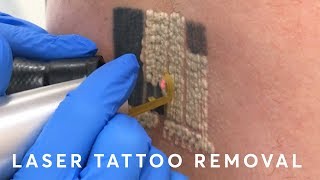 Laser Tattoo Removal PAIN RESULTS amp PROCEDURE [upl. by Aerdnael989]