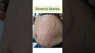 Stretch Marks amp Steroids Side Effects  चेहरे पर सूजन चमड़ी का लाल और पतला होना stretchmarkcream [upl. by Lebiram]