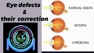 Eye defects class 10 [upl. by Htebezile430]