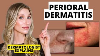 Dermatologist Explains Perioral Dermatitis What it Looks Like Causes amp Treatments  Dr Sam Ellis [upl. by Enelrak]