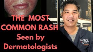 How to treat Perioral Dermatitis Dermatologist Explains [upl. by Fidela615]