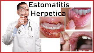 Estomatitis Herpetica y Herpes Simple  Etiologia Signos SintomasTratamiento Diagnostico VSH1 [upl. by Sadirah]