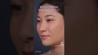 How to Get Cheek amp Jawline Contouring with Buccal Fat Removal [upl. by Romano]