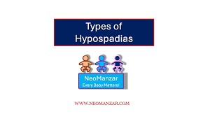 Hypospadias Types Newborn Infants [upl. by Sheffield]