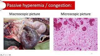 Hyperemia and congestion [upl. by Mannie]