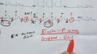 2ND DEGREE AV BLOCK TYPE 1 [upl. by Euhsoj]