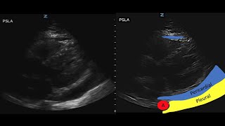 Cardiac Tamponade Ultrasound 122019 [upl. by Dibb]