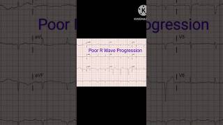 Poor R wave progression Significance of Poor R wave in ECG [upl. by Ahsyt]