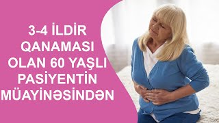 34 İLDİR QANAMASI OLAN 60 YAŞLI PASİYENTİN MÜAYİNƏSİNDƏN [upl. by Torres]