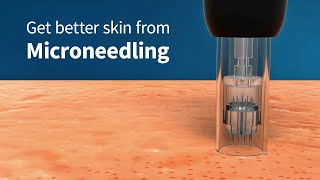 How Microneedling Improves Skin Firmness and Complexion Collagen Induction Therapy [upl. by Virge]