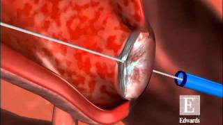 Edwards Sapien Transcatheter Heart Valve Animation [upl. by Hedaza]