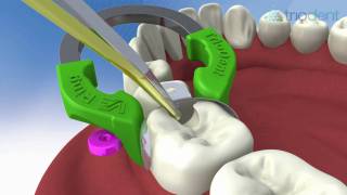 Triodent V3 Sectional Matrix System Animation VoiceOver [upl. by Adham]