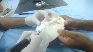 Hypertelorism correction and Box osteotomies part 3 Dr Derick Mendonca [upl. by Tnelc]