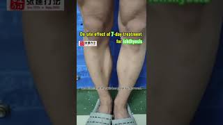 Listen to the ichthyosis patients voice ichthyosis dryskinremedy skincare dermatologist [upl. by Yekim]