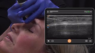 Dissolving Filler in the Forehead [upl. by Monti]