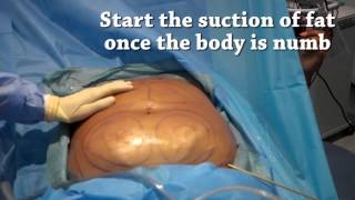 How is liposuction performed  Centre for Surgery [upl. by Enelec]