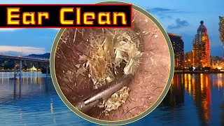 Ear wax removal Cleaning ear wax [upl. by Nosnehpets643]