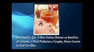 Remedios Caseros Para el Acne Como Eliminar Acne Rapido [upl. by Ehttam]