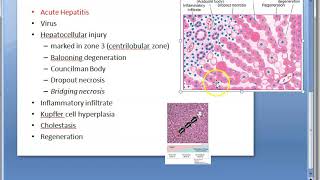 Pathology 616 b Councilman bodies hepatic viral hepatitis liver histology [upl. by Tuneberg]