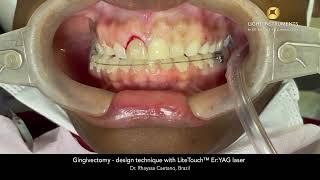 Gingivectomy  design technique with LiteTouch™ ErYAG laser [upl. by Aiello]