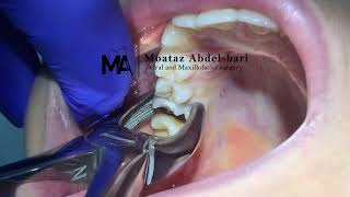 extraction of upper first molar using forceps [upl. by Naul543]