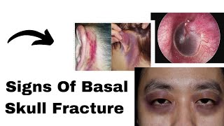 Signs of Basal Skull Fracture  Medical Corps 🩺 [upl. by Ettennahs]