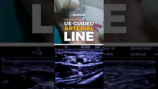 UltrasoundGuided Arterial Line ultrasound arterial nysora [upl. by Keavy]