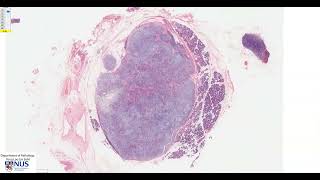 Salivary gland Pleomorphic adenoma Microscopy  Talking slide [upl. by Alleinad652]