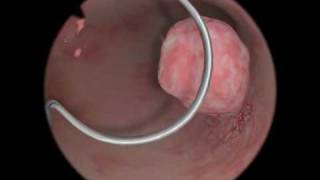 Polypectomy  Polyp Removal  Virtual Reality Simulation for Endoscopic Surgery [upl. by Orvil]