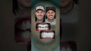 Smile Transformation in Just 5 Days with Zirconium Crowns [upl. by Nanyt]