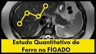 Estudo Quantitativo de Ferro Hepático na Ressonância Magnética [upl. by Fidela]