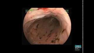 Hemorrhagic Gastropathy [upl. by Omsoc763]