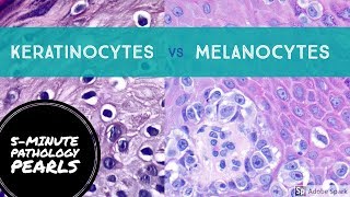 Melanocytes vs Keratinocytes Made Easy 5Minute Pathology Pearls [upl. by Ykcim]